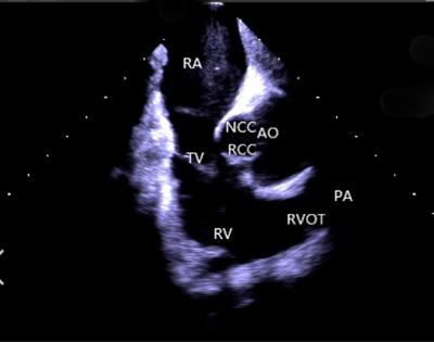 Understanding the scope of intracardiac echocardiography in catheter ablation of ventricular arrhythmia